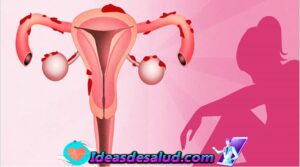 Endometriosis: todo lo que debes saber sobre esta padecimiento