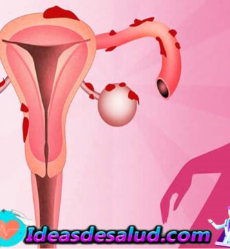 Endometriosis: todo lo que debes saber sobre esta padecimiento