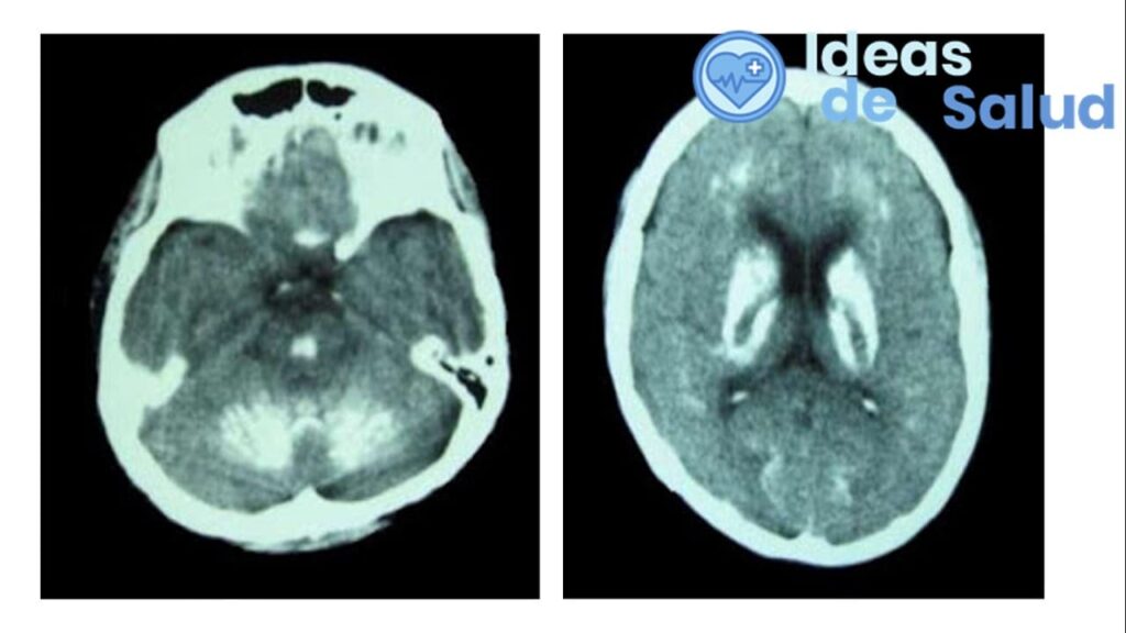 ¿Cuáles son los síntomas de calcificación en el cerebro?