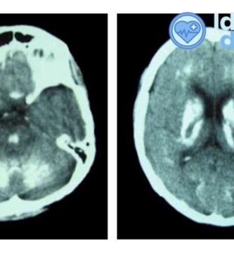 ¿Cuáles son los síntomas de calcificación en el cerebro?