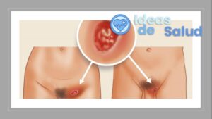 ¿Cuáles son los síntomas del herpes genital femenino y masculino?