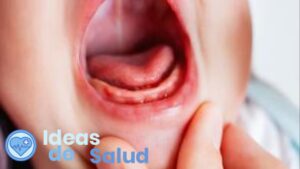Prevención del sapito en la boca del bebe