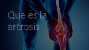 ¿Qué es la artrosis?