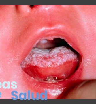 Un sapito en la boca del bebé, ¿Qué es, cuáles son los síntomas y cómo lo trato?